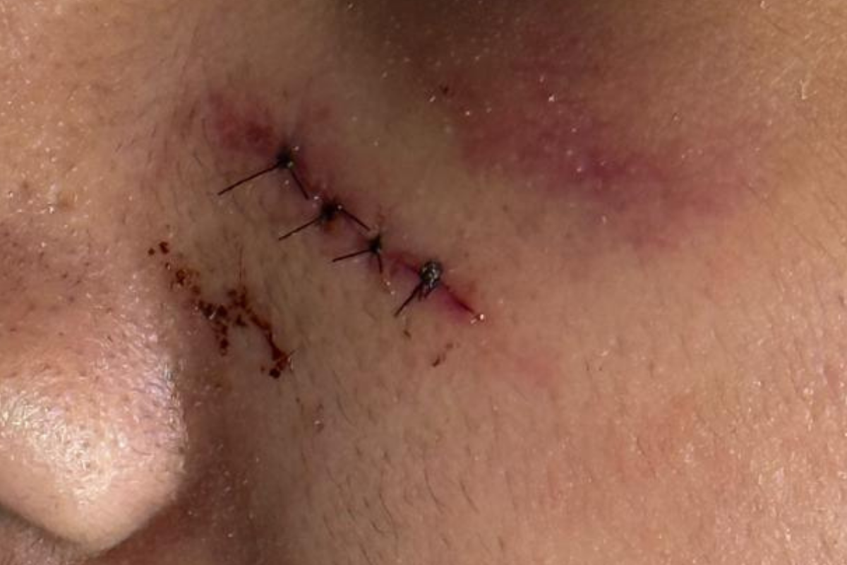 Vítima foi atingida no rosto e na cabeça e teve arranhões no maxilar.