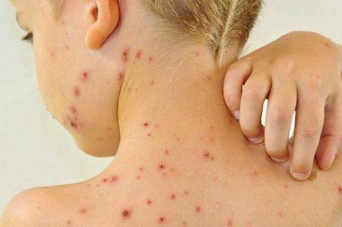 A catapora é uma doença altamente contagiosa, causada por um vírus do grupo herpes