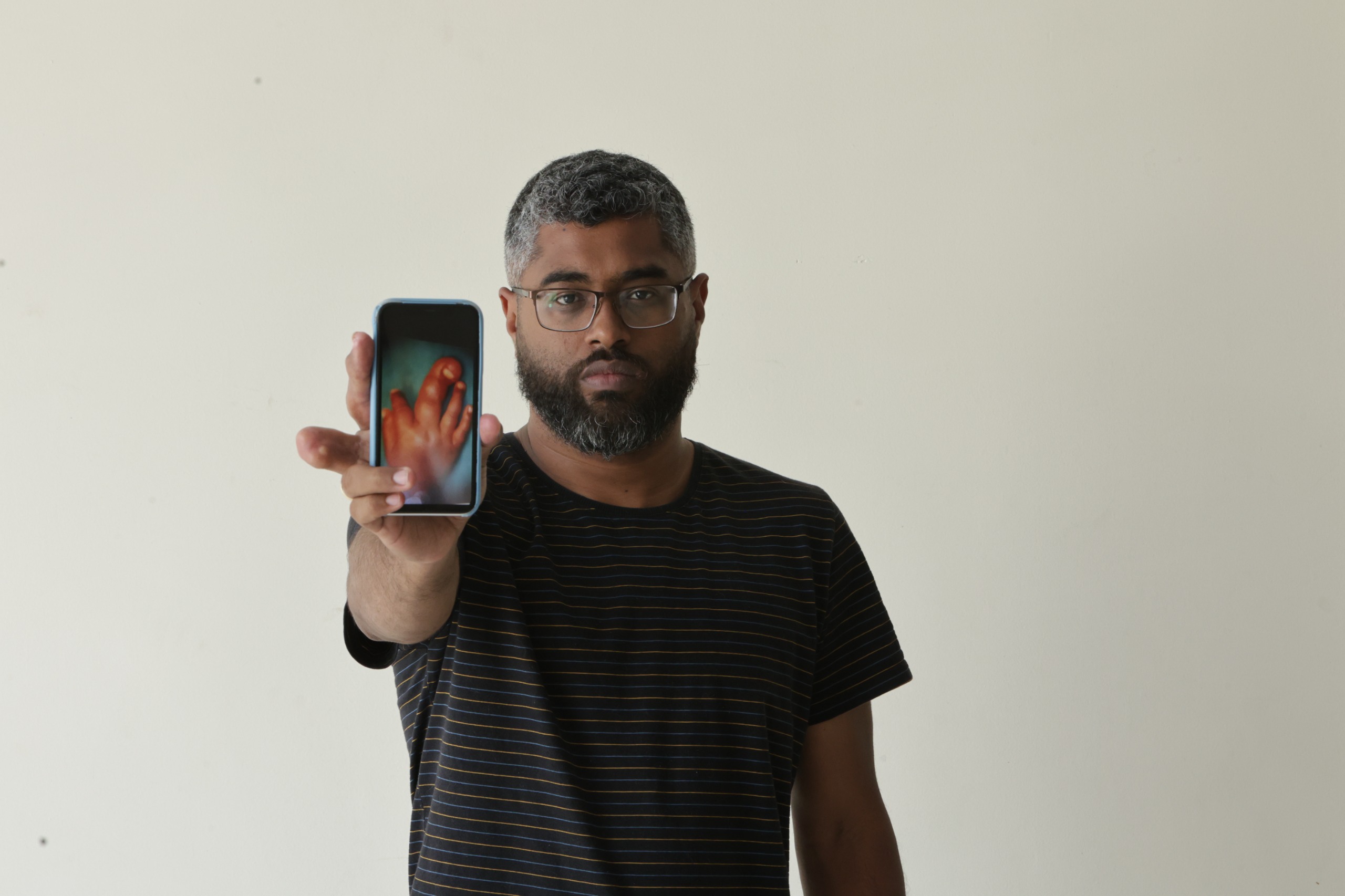 Cledemar Duarte nasceu com um dedo da mão excessivamente grande